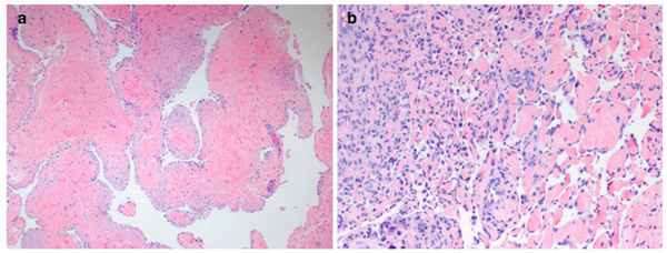 Глубоко залегающие сосуды - венозная мальформация