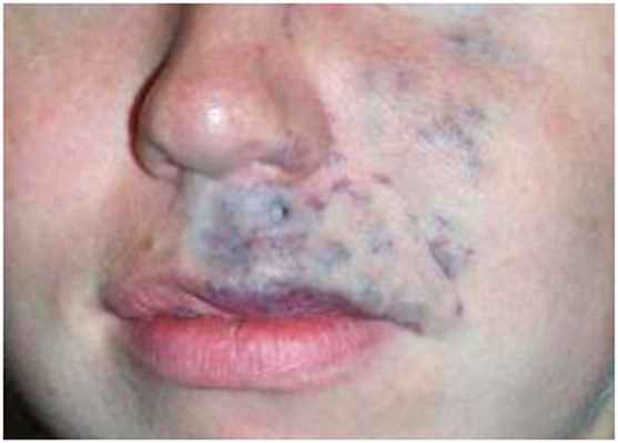 Глубоко залегающие сосуды - венозная мальформация на лице