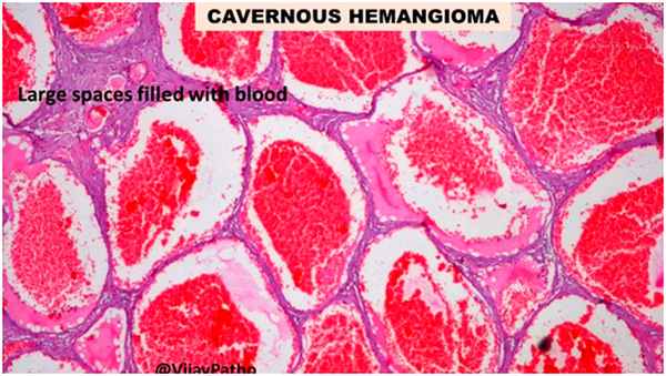 Глубоко залегающие сосуды - гистологическая картина кавернозной гемангиомы