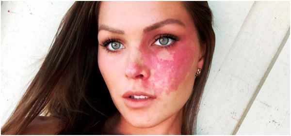 Глубоко залегающие сосуды - винное пятно во взрослом возрасте