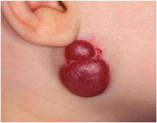 Глубоко залегающие сосуды - кавернозная гемангиома