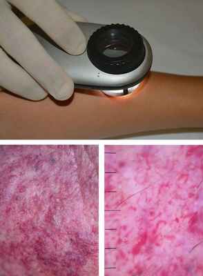 Дерматоскопия капиллярной мальформации