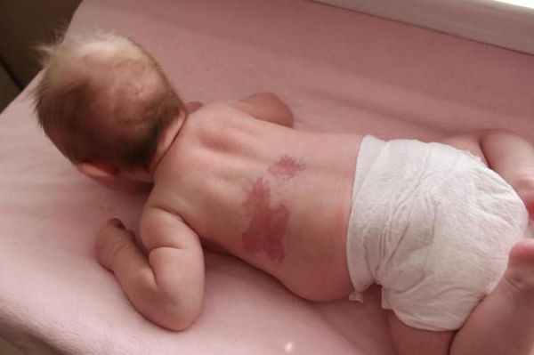 Капиллярная ангиодисплазия