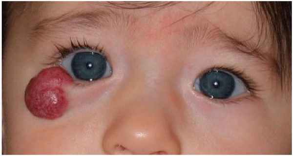 Глубоко залегающие сосуды - капиллярная гемангиома на нижнем веке