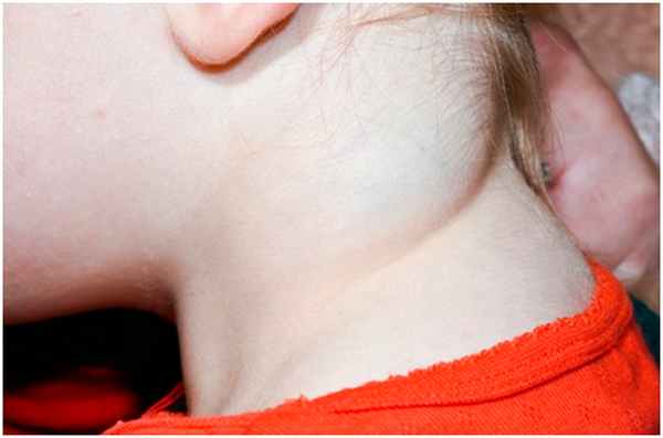 Глубоко залегающие сосуды - лимфатическая мальформация на шее