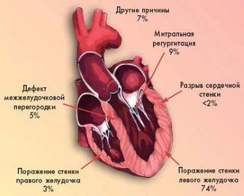 Причины кардиогенного шока
