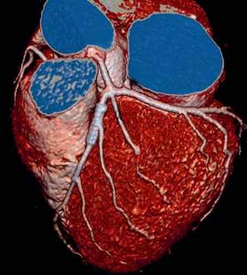 Коронарография