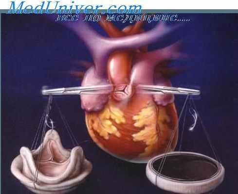 инфаркт миокарда