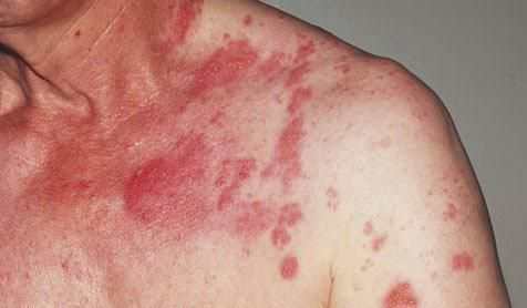 Высыпание при карциноидном синдроме