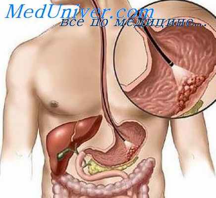 опухоли желудка