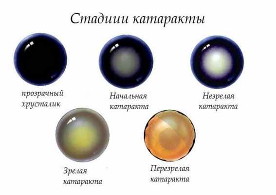 Стадии развития заболевания