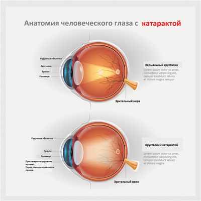 Катаракта.jpg