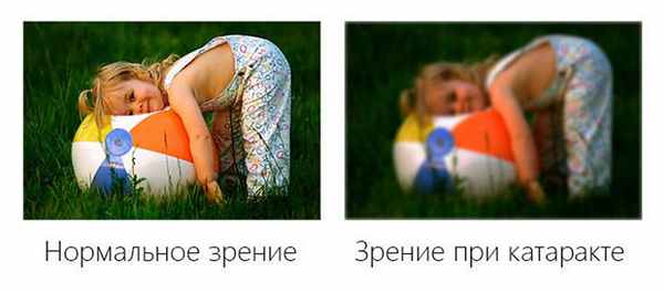 Лечение катаракты