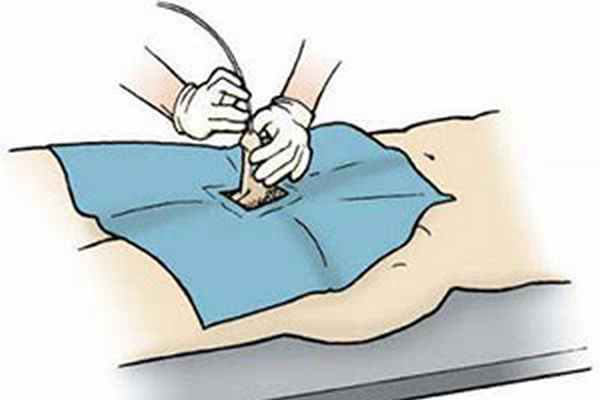 Этапы и ключевые моменты катетеризации мочевого пузыря у мужчин