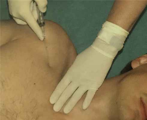 подключичный доступ при катетеризации