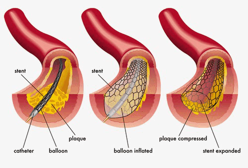 Катеторизация