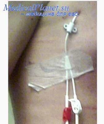 катетеризация вен