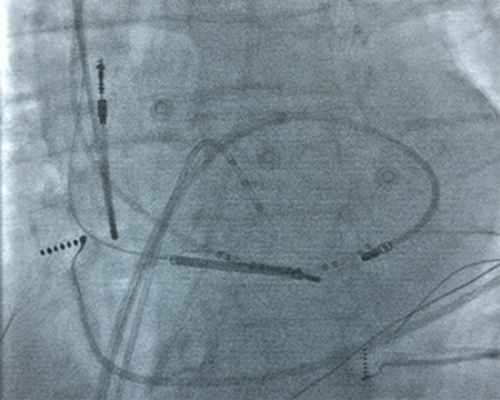 Рисунок 2. Rg-стоп кадр при выполнение РЧА очага ЖТ в ЛЖ, транссептальным доступом