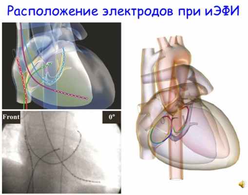 Радиочастотная аблация сердца