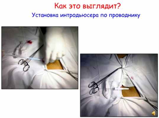 Радиочастотная аблация сердца