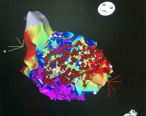 Рисунок 1. РЧА очага желудочковой тахикардии при электрическом шторме