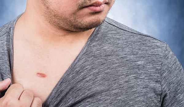 Келоидный рубец