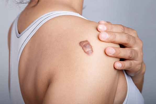 Келоидный рубец