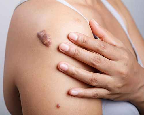 Келоидный рубец