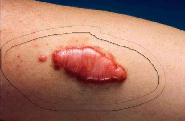 Келоидный рубец