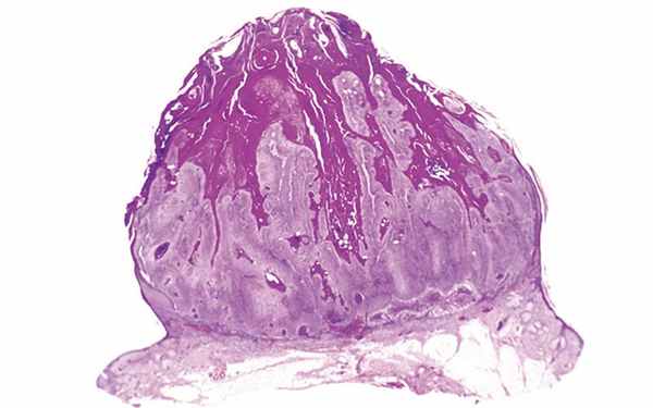 причины возникновения кератоакантомы