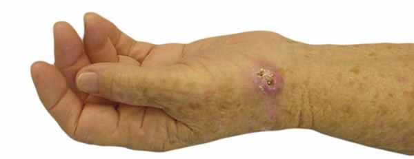 кератоакантома симптом-2