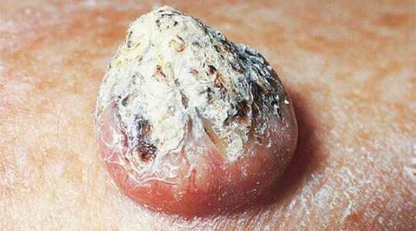 Кератоакантома