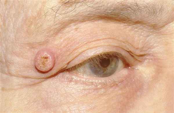 кератоакантома симптом-1