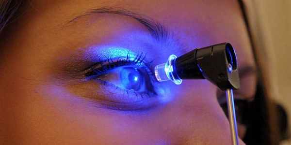 Кератоконус