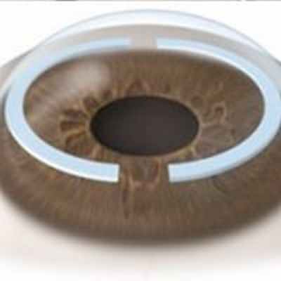 Имплантация стромальных колец при лечении кератоконуса - Центра глазной хирургии по лечению глаз, коррекции и восстановлению зрения при помощи лазера.