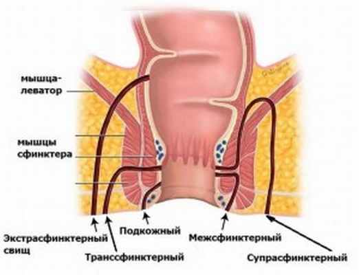 Классификация свищей толстой кишки