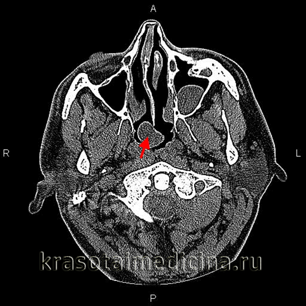 КТ головы. Кистозное объемное образование в области задней стенки носоглотки (киста Торнвальдта)
