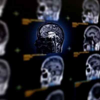 Киста головного мозга