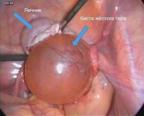 Удаление кисты желтого тела