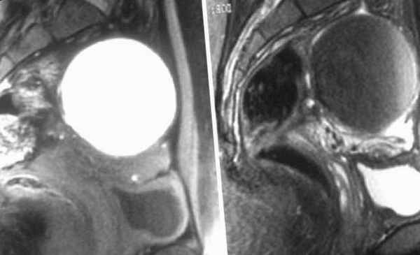 Лечение кисты желтого тела в Калининграде