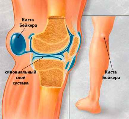 киста бейкера фото