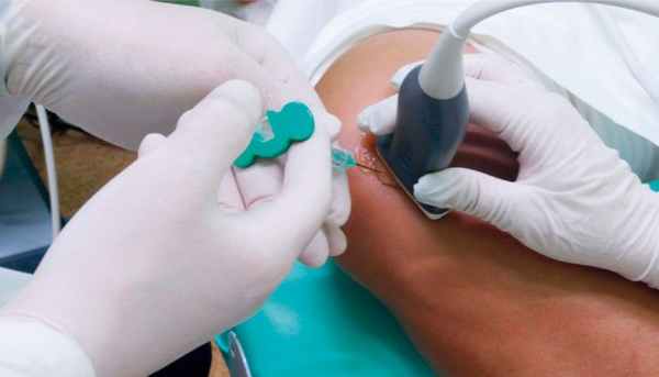 Пункция кисты Бейкера