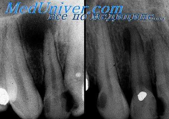 зубные кисты