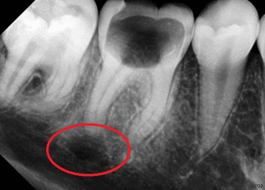 Рентген диагностика при кисте зуба
