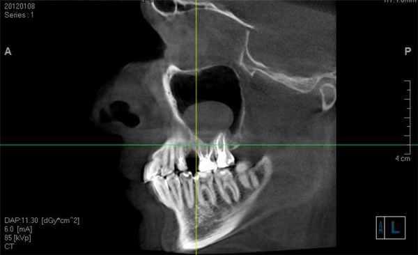 Одонтогенная киста на рентгене
