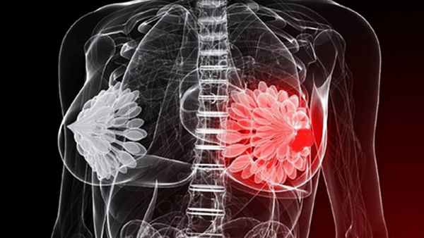 киста молочной железы