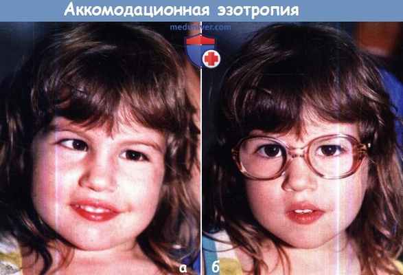 Аккомодационная эзотропия