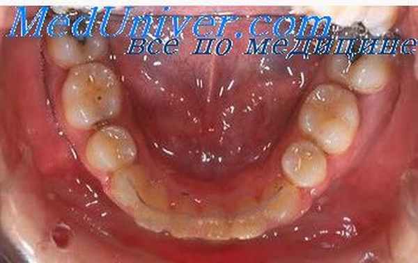 аномалии прикуса