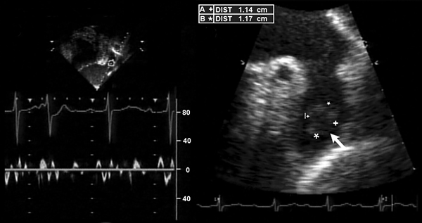 Тромб в левом предсердии