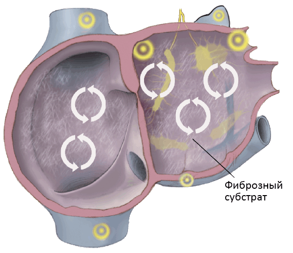 Патофизиология фибрилляции предсердий